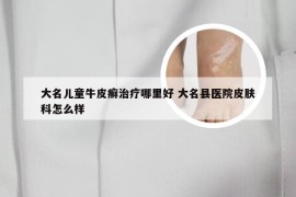 大名儿童牛皮癣治疗哪里好 大名县医院皮肤科怎么样