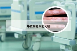 牛皮癣能不能化验