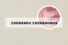 泛发型银屑病特点 泛发型银屑病诊断标准