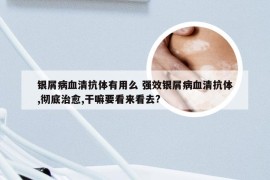 银屑病血清抗体有用么 强效银屑病血清抗体,彻底治愈,干嘛要看来看去?