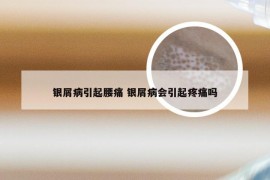 银屑病引起腰痛 银屑病会引起疼痛吗