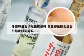 多囊卵巢会诱发银屑病吗 多囊卵巢综合症会引起皮肤问题吗