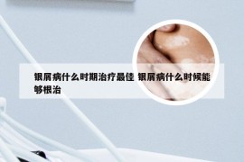 银屑病什么时期治疗最佳 银屑病什么时候能够根治