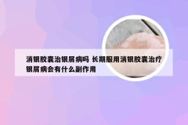 消银胶囊治银屑病吗 长期服用消银胶囊治疗银屑病会有什么副作用