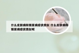 什么皮肤病和银屑病症状类似 什么皮肤病和银屑病症状类似呢
