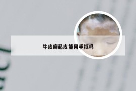 牛皮癣起皮能用手抠吗