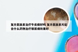复方氨肽素治疗牛皮癣好吗 复方氨肽素片配合什么药物治疗银屑病效果好