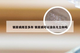 银屑病用百多邦 银屑病可以涂白凡士林吗