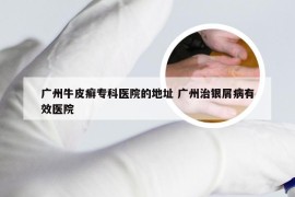 广州牛皮癣专科医院的地址 广州治银屑病有效医院