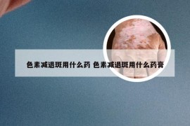 色素减退斑用什么药 色素减退斑用什么药膏