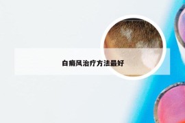 白癜风治疗方法最好