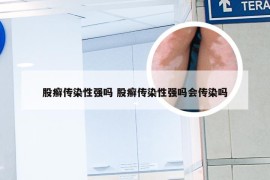 股癣传染性强吗 股癣传染性强吗会传染吗