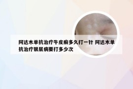 阿达木单抗治疗牛皮癣多久打一针 阿达木单抗治疗银屑病要打多少次