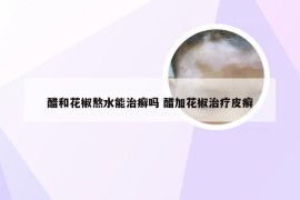 醋和花椒熬水能治癣吗 醋加花椒治疗皮癣