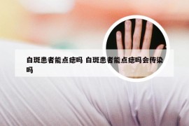 白斑患者能点痣吗 白斑患者能点痣吗会传染吗
