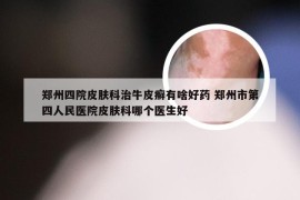 郑州四院皮肤科治牛皮癣有啥好药 郑州市第四人民医院皮肤科哪个医生好