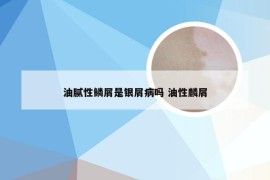 油腻性鳞屑是银屑病吗 油性麟屑