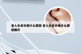 老人头皮长癣什么原因 老人头皮长癣什么原因图片