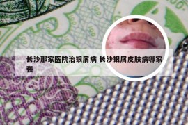 长沙那家医院治银屑病 长沙银屑皮肤病哪家强