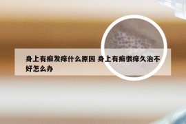 身上有癣发痒什么原因 身上有癣很痒久治不好怎么办