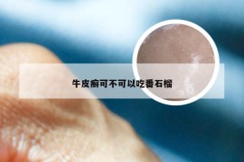 牛皮癣可不可以吃番石榴
