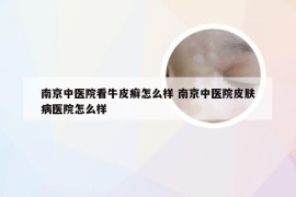 南京中医院看牛皮癣怎么样 南京中医院皮肤病医院怎么样
