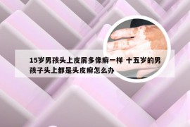 15岁男孩头上皮屑多像癣一样 十五岁的男孩子头上都是头皮癣怎么办
