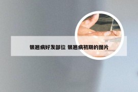 银翘病好发部位 银翘病初期的图片