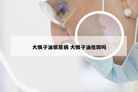 大枫子油银屑病 大枫子油祛斑吗