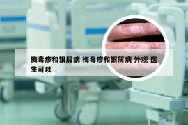 梅毒疹和银屑病 梅毒疹和银屑病 外观 医生可以