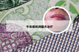 牛皮癣民间偏方治疗