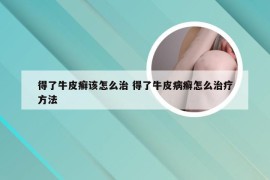 得了牛皮癣该怎么治 得了牛皮病癣怎么治疗方法