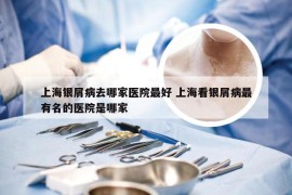 上海银屑病去哪家医院最好 上海看银屑病最有名的医院是哪家