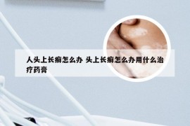 人头上长癣怎么办 头上长癣怎么办用什么治疗药膏