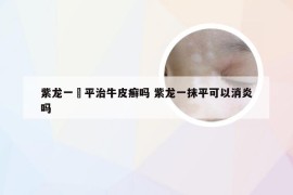 紫龙一抺平治牛皮癣吗 紫龙一抹平可以消炎吗