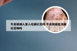 牛皮癣病人客人吃藏红花吗 牛皮肤癣能泡藏红花喝吗