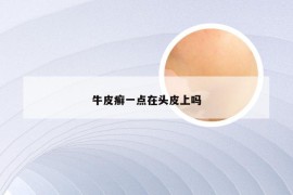 牛皮癣一点在头皮上吗