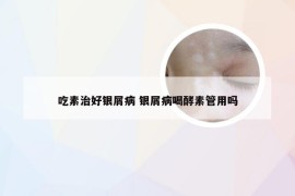 吃素治好银屑病 银屑病喝酵素管用吗