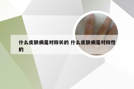 什么皮肤病是对称长的 什么皮肤病是对称性的