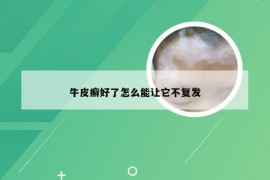 牛皮癣好了怎么能让它不复发