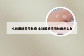 小孩眼睛周围长癣 小孩眼睛周围长癣怎么办