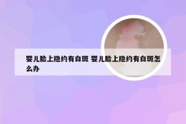 婴儿脸上隐约有白斑 婴儿脸上隐约有白斑怎么办