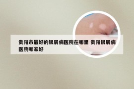 贵阳市最好的银屑病医院在哪里 贵阳银屑病医院哪家好