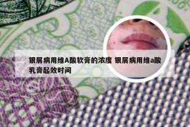 银屑病用维A酸软膏的浓度 银屑病用维a酸乳膏起效时间