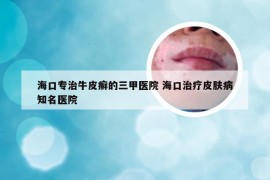 海口专治牛皮癣的三甲医院 海口治疗皮肤病知名医院