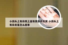 小孩头上有白斑上面有很多白皮屑 小孩头上有白皮是怎么回事