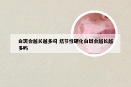 白斑会越长越多吗 结节性硬化白斑会越长越多吗