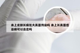 身上皮肤长癣处大真菌传染吗 身上长真菌感染癣可以自愈吗