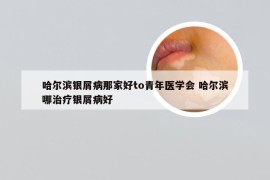 哈尔滨银屑病那家好to青年医学会 哈尔滨哪治疗银屑病好