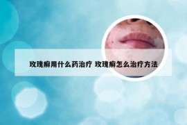 玫瑰癣用什么药治疗 玫瑰癣怎么治疗方法